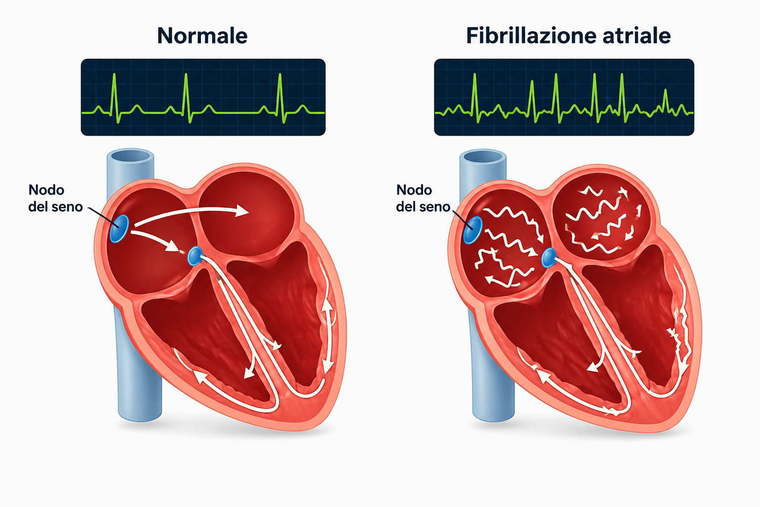 Fibrillazione atriale e ipertensione — schema clinico